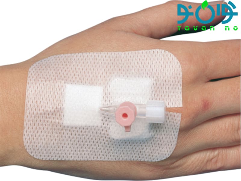 چسب آنژیوکت چیست و چه کاربردهایی دارد؟